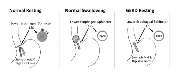 Illustration of the Lower Esophageal Sphincter