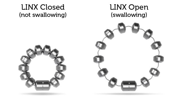 Illustration showing the LINX Device Closed and Open